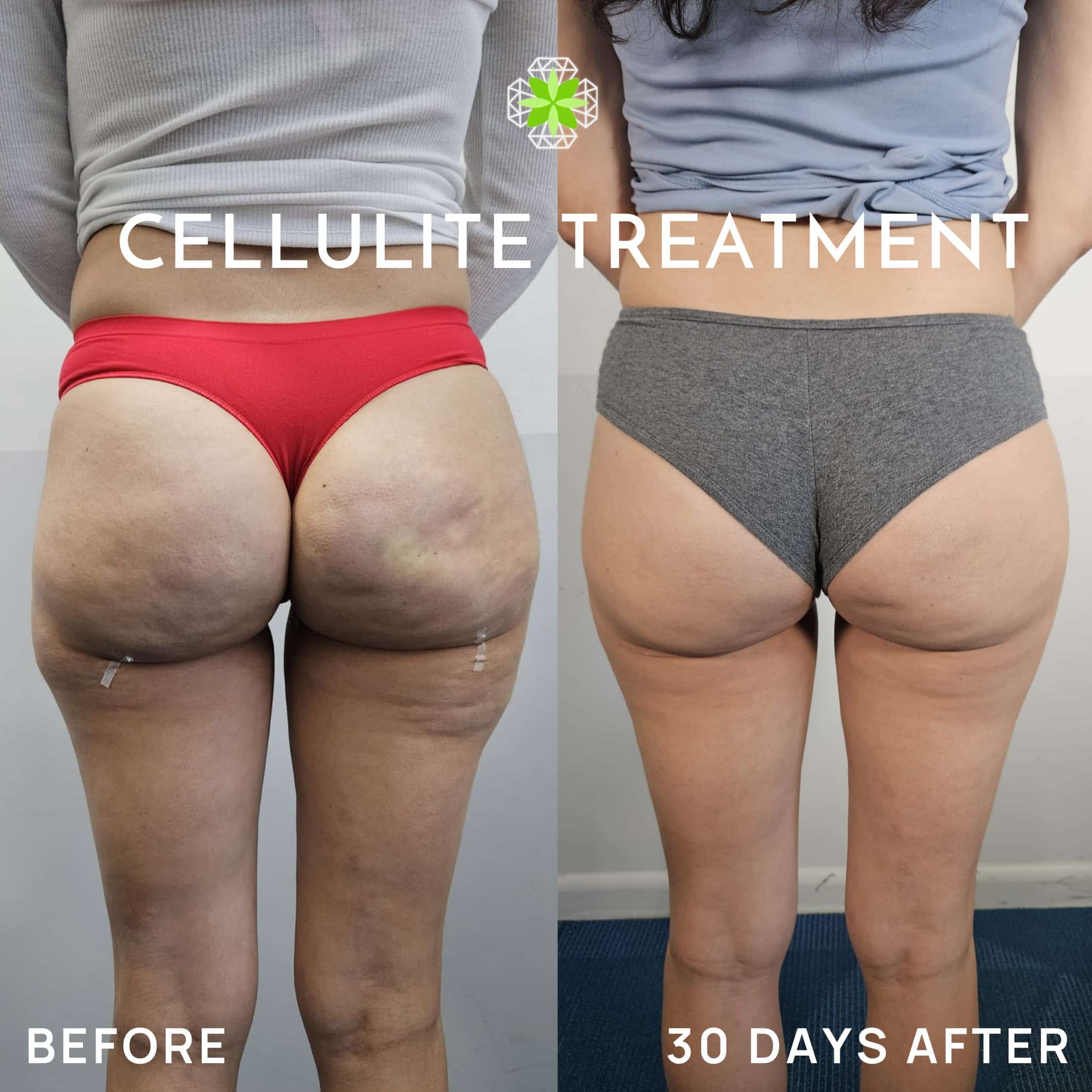 Cellulite before and after (1)