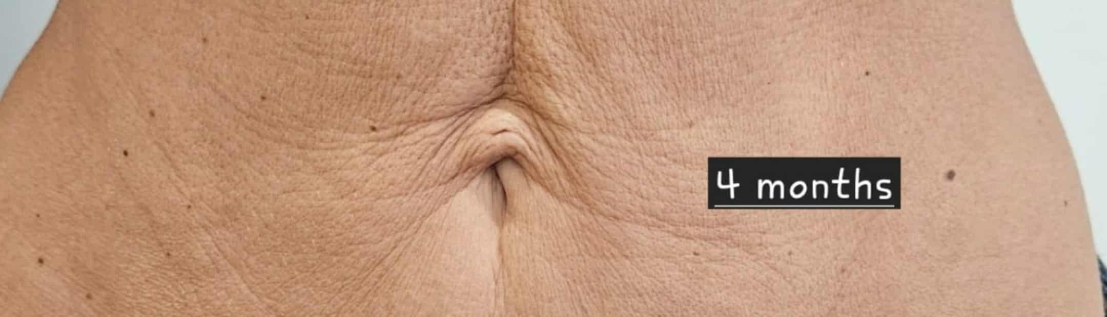 after PDO Thread Lift For Abdomen Boca Raton FL