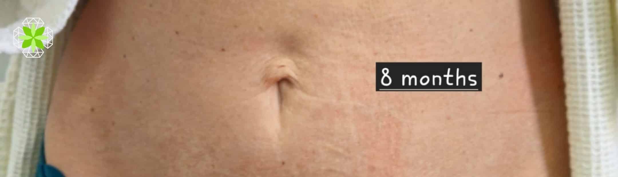 after PDO Thread Lift Treatment For Abdomen Boca Raton FL