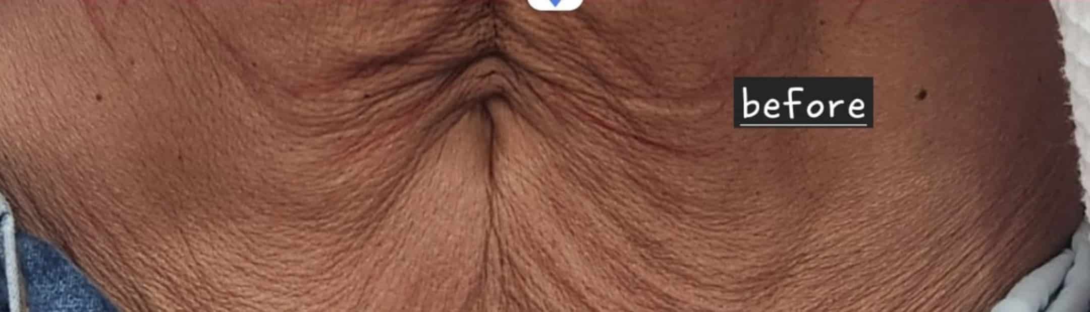 before PDO Thread Lift Treatment For Abdomen Boca Raton FL